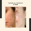 SkinTra - C-Acid - Kyselinová kúra s vitamínom C - 30ml