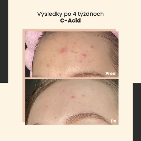 SkinTra - C-Acid - Kyselinová kúra s vitamínom C - 30ml