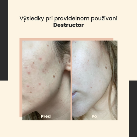 SkinTra - Destructor - Celoročný kyselinový peeling 24% - 30ml