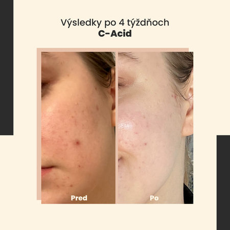 SkinTra - C-Acid - Kyselinová kúra s vitamínom C - 30ml