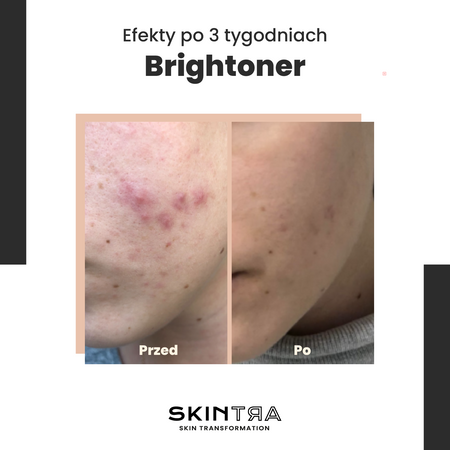 SkinTra - Brightoner - Celoročné kyselinové tonikum 9% - 100ml